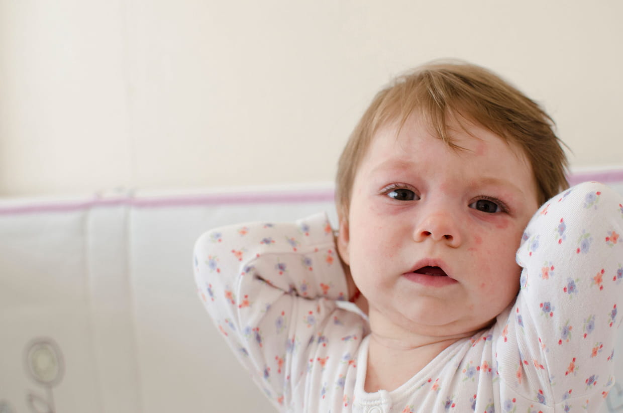 La roséole, une maladie fréquente chez l'enfant